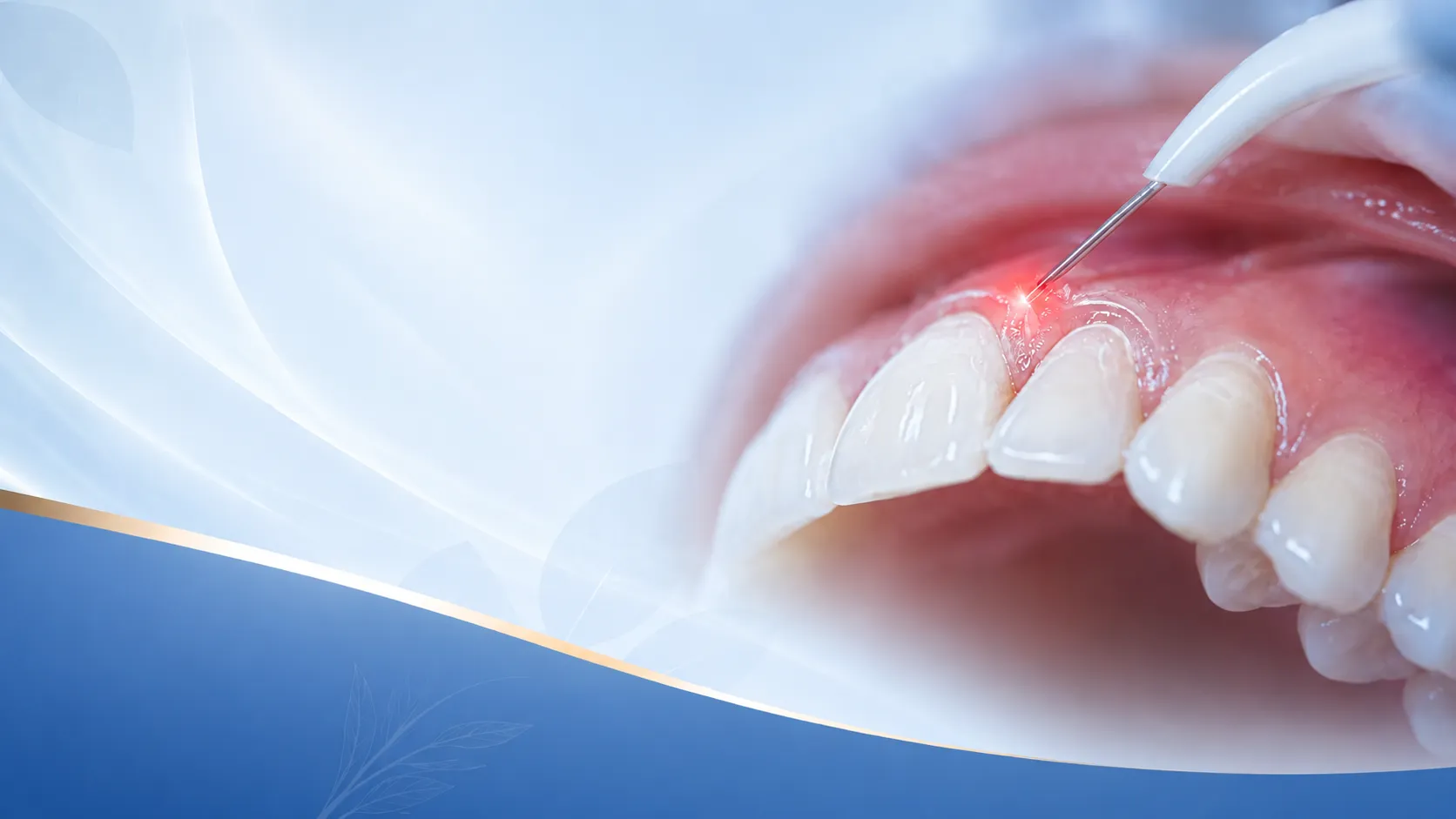 Laser Dentistry